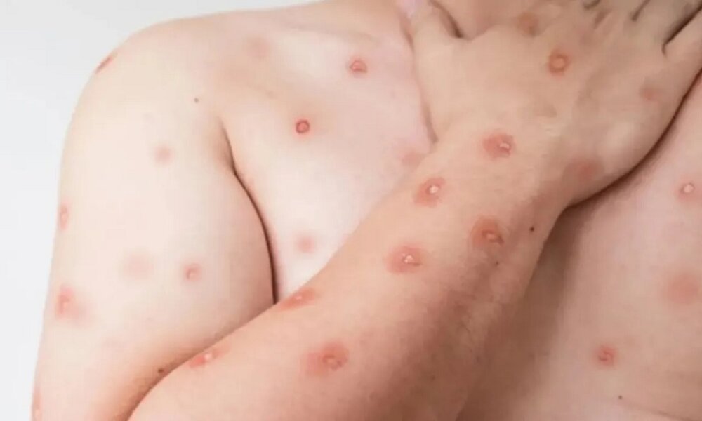 Porto Alegre confirma primeiro caso de mpox em 2026; paciente contraiu vírus fora do Estado