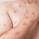 Porto Alegre confirma primeiro caso de mpox em 2026; paciente contraiu vírus fora do Estado